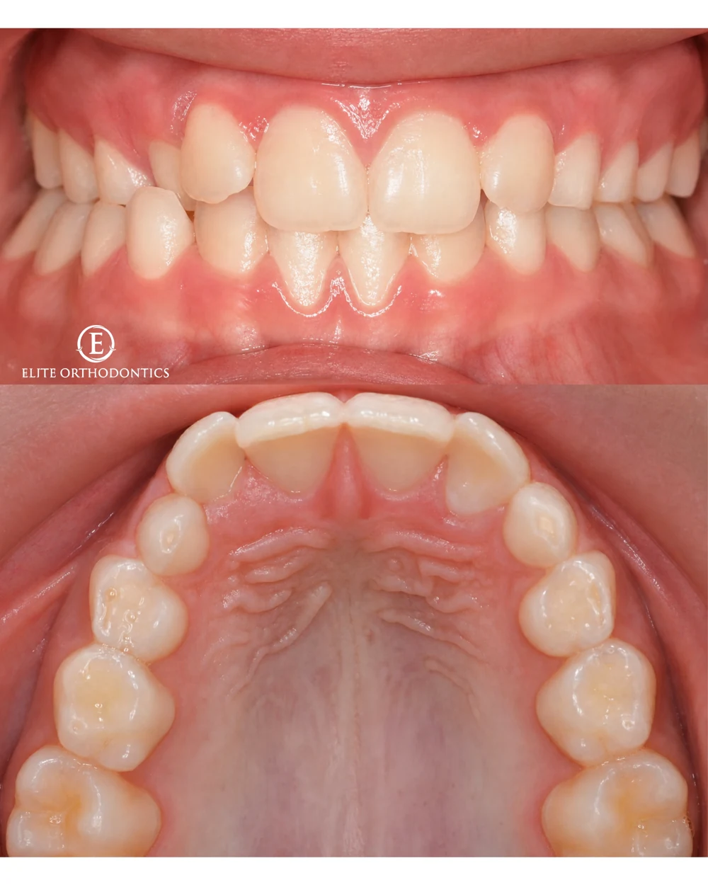 A different relationship. A coordinated bite.: clinical image 2 of 6