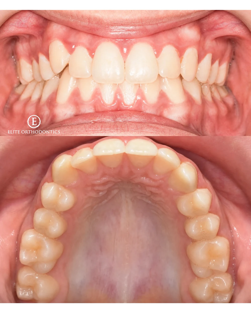 A different relationship. A coordinated bite.: clinical image 4 of 6