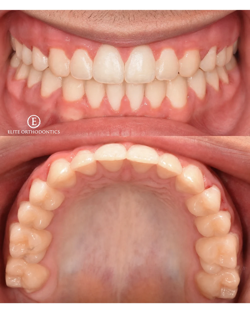 A different relationship. A coordinated bite.: clinical image 6 of 6