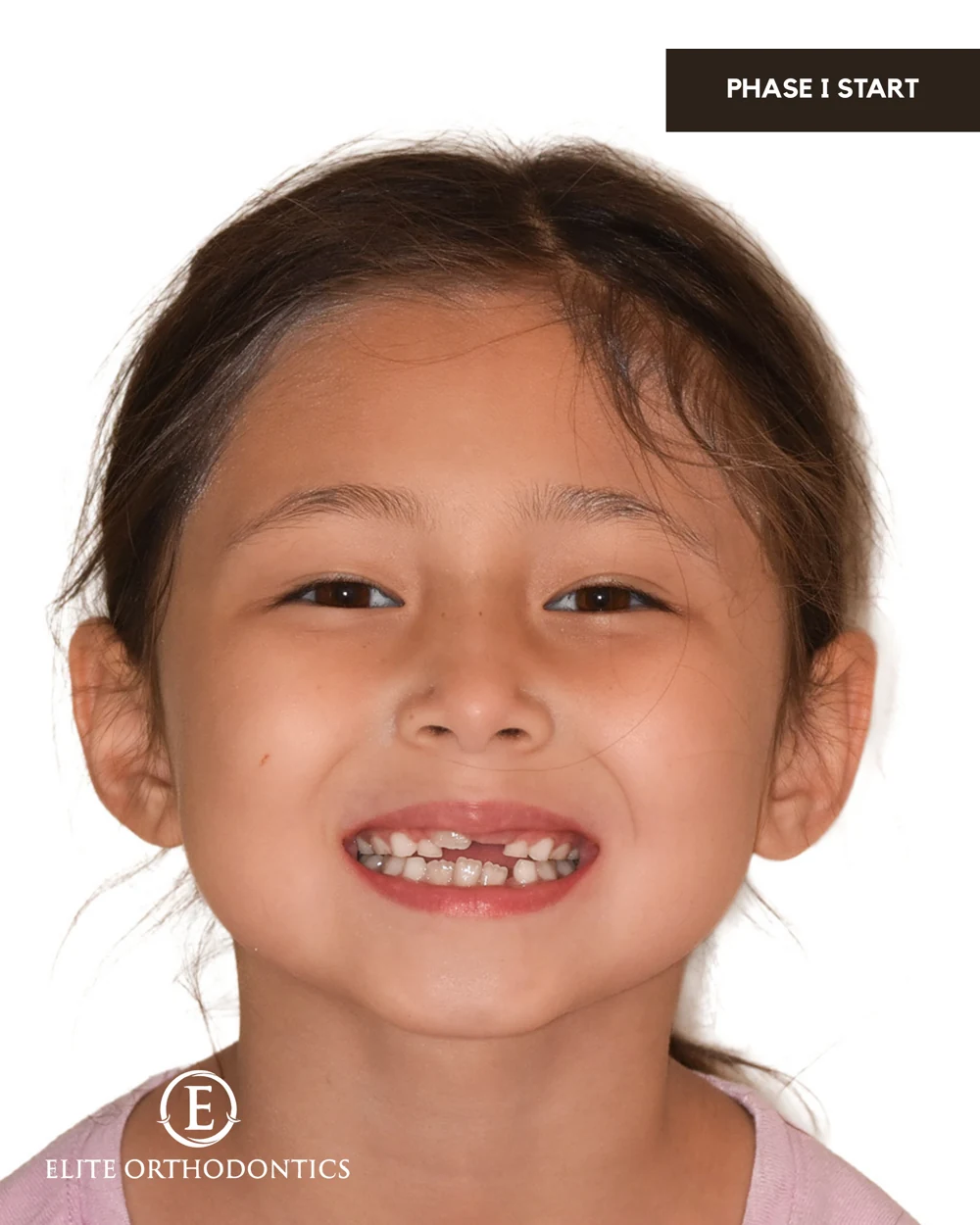 Making room for development.: clinical image 2 of 8