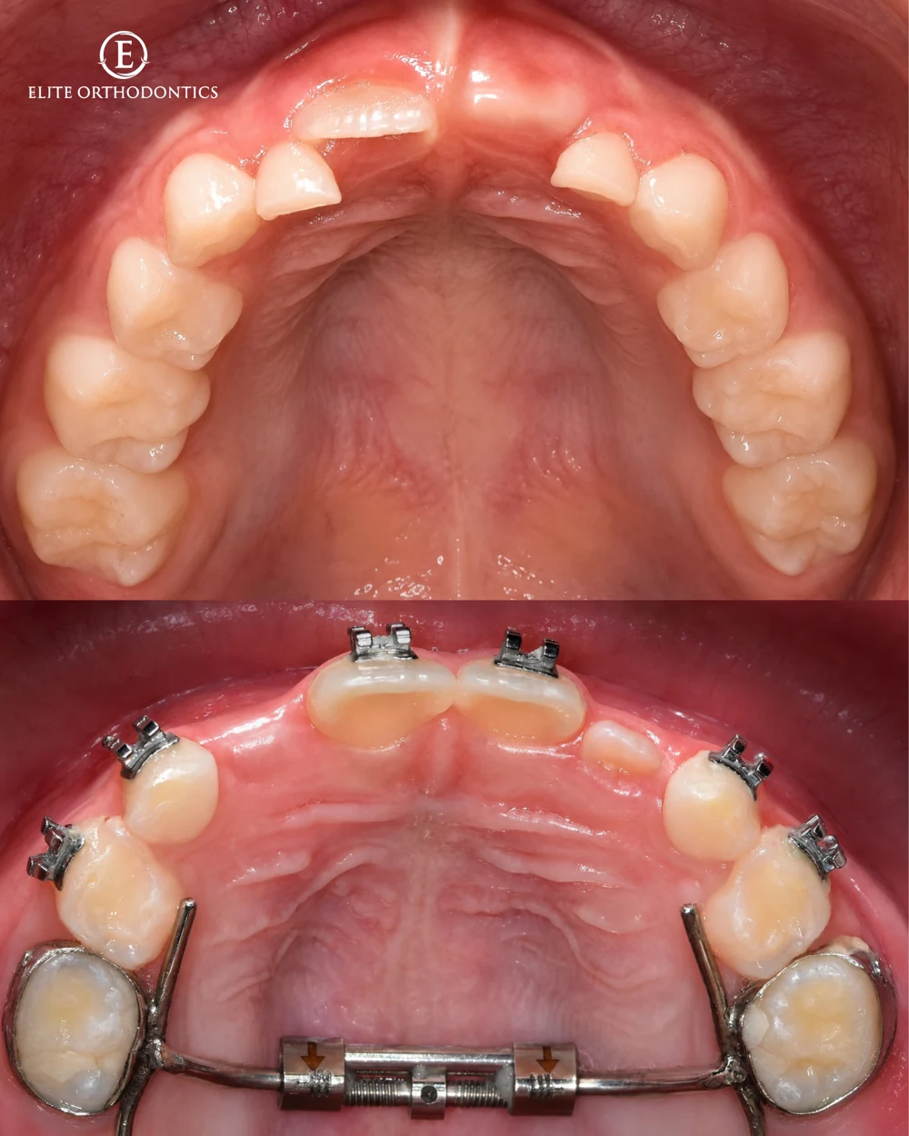 Making room for development.: clinical image 3 of 8